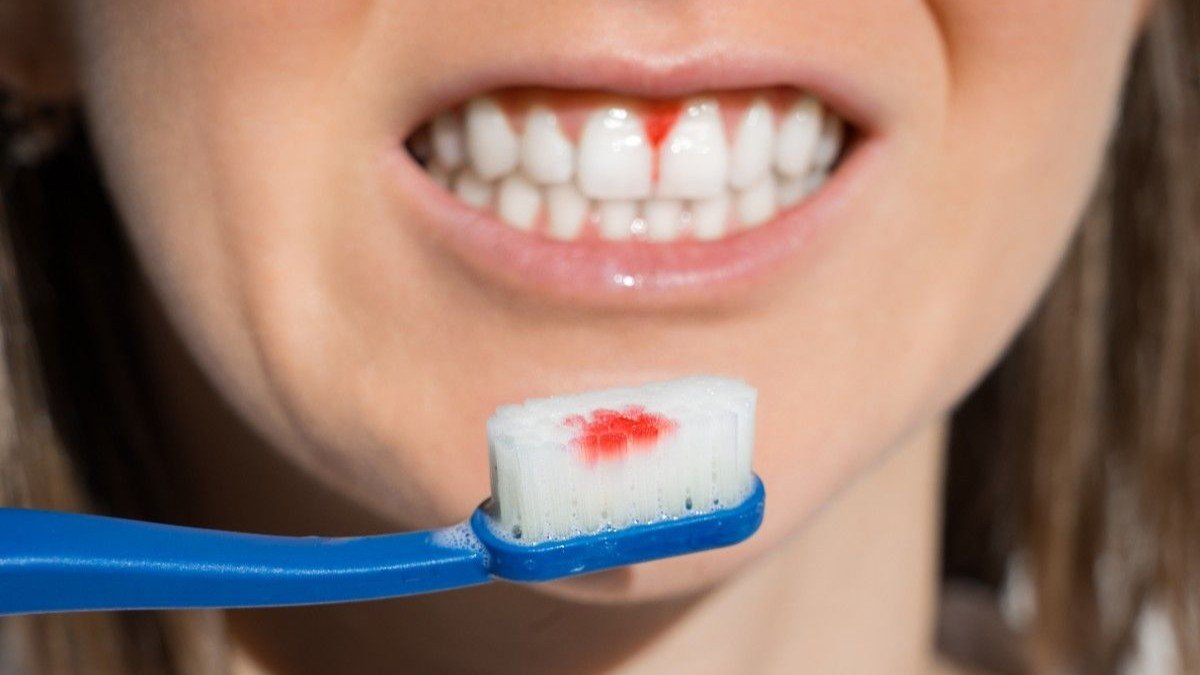 Why Are My Gums Bleeding Real Reasons And Simple Fixes