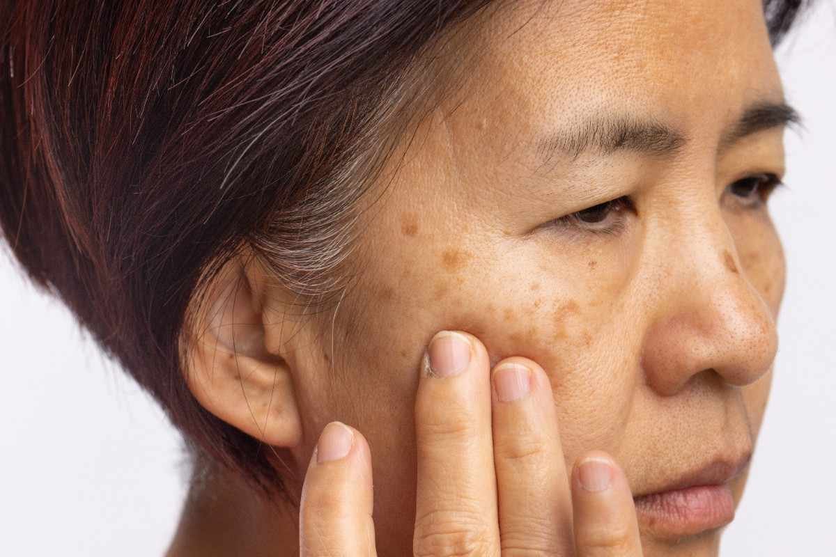 How To Get Rid Of Age Spots Naturally For Clear Skin